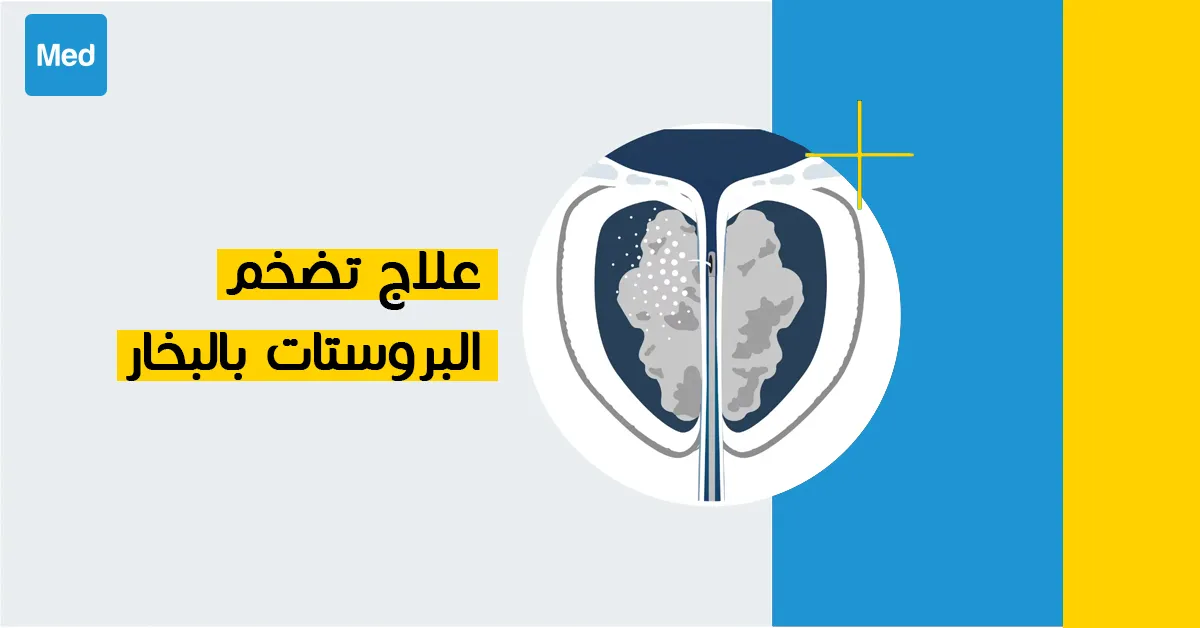 علاج تضخم البروستات بالبخار